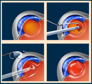 Лечение катаракты в Израиле