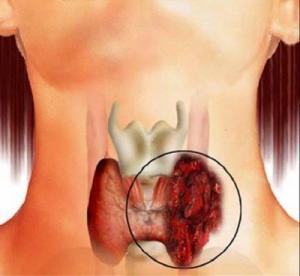 Рак щитовидной железы: лечение в Израиле