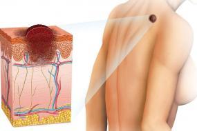 Израильские ученые поняли причины высокой агрессивности меланомы